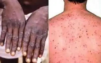 मंकीपॉक्स को इग्नोर करने से बचिए!