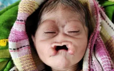 बिहार में पैदा हुआ बिना नाक का बच्चा